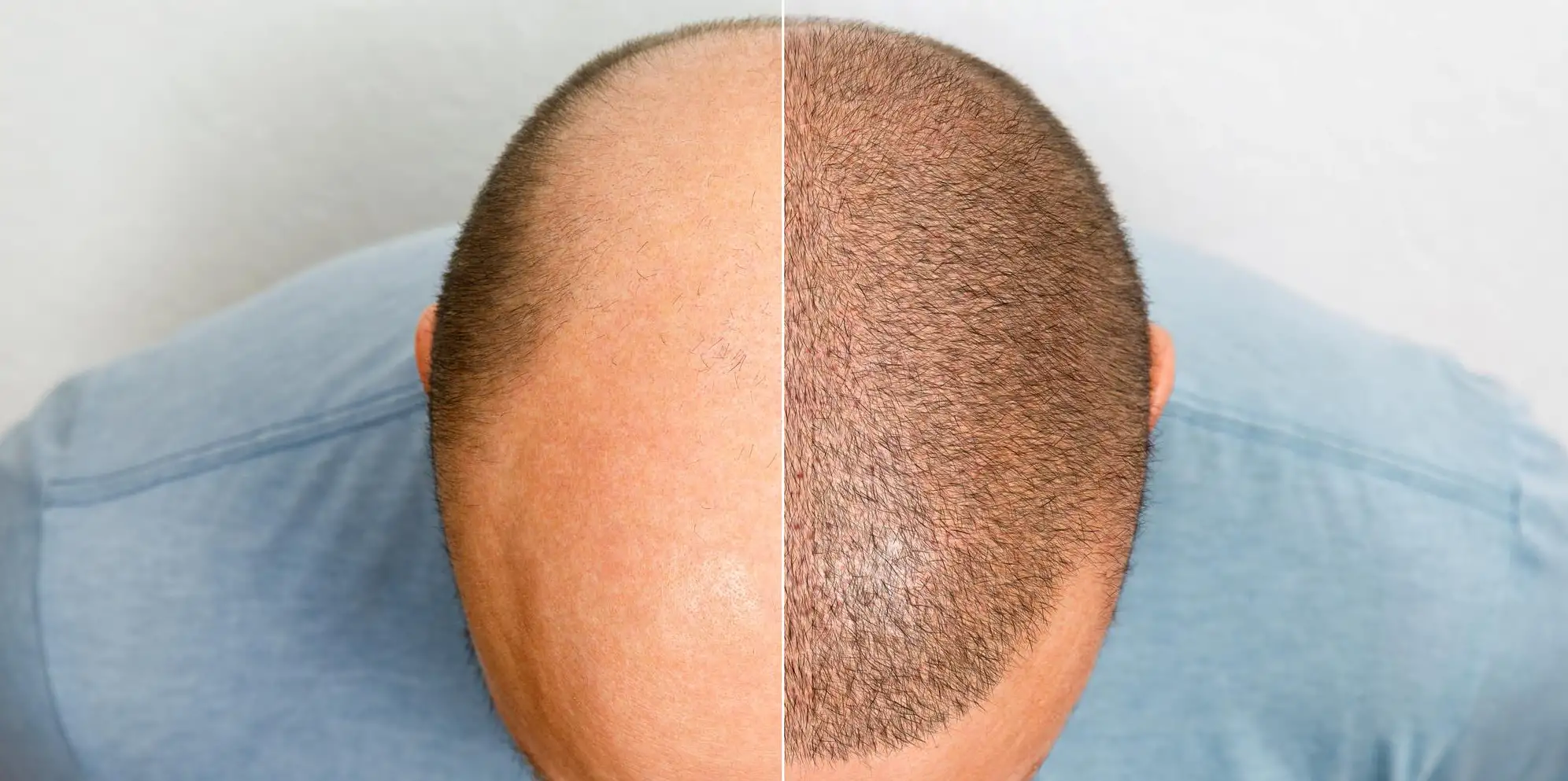Best Hair Transplant in Chhattisgarh - Mahaveer Hair Solution